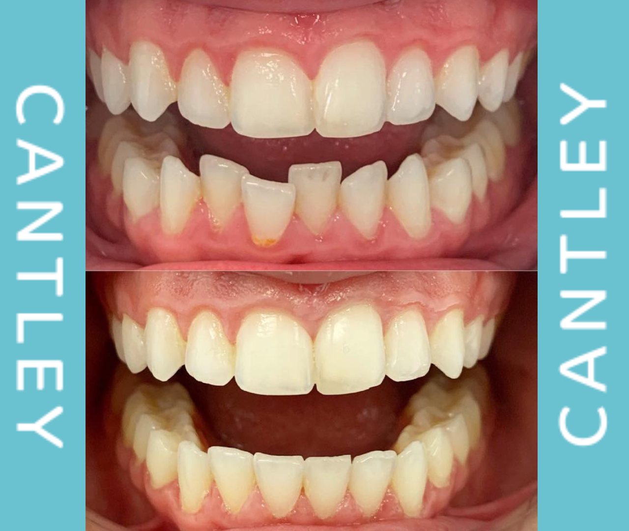 Invisalign Teeth Straightening Dental Treatment Cantley Dental Care