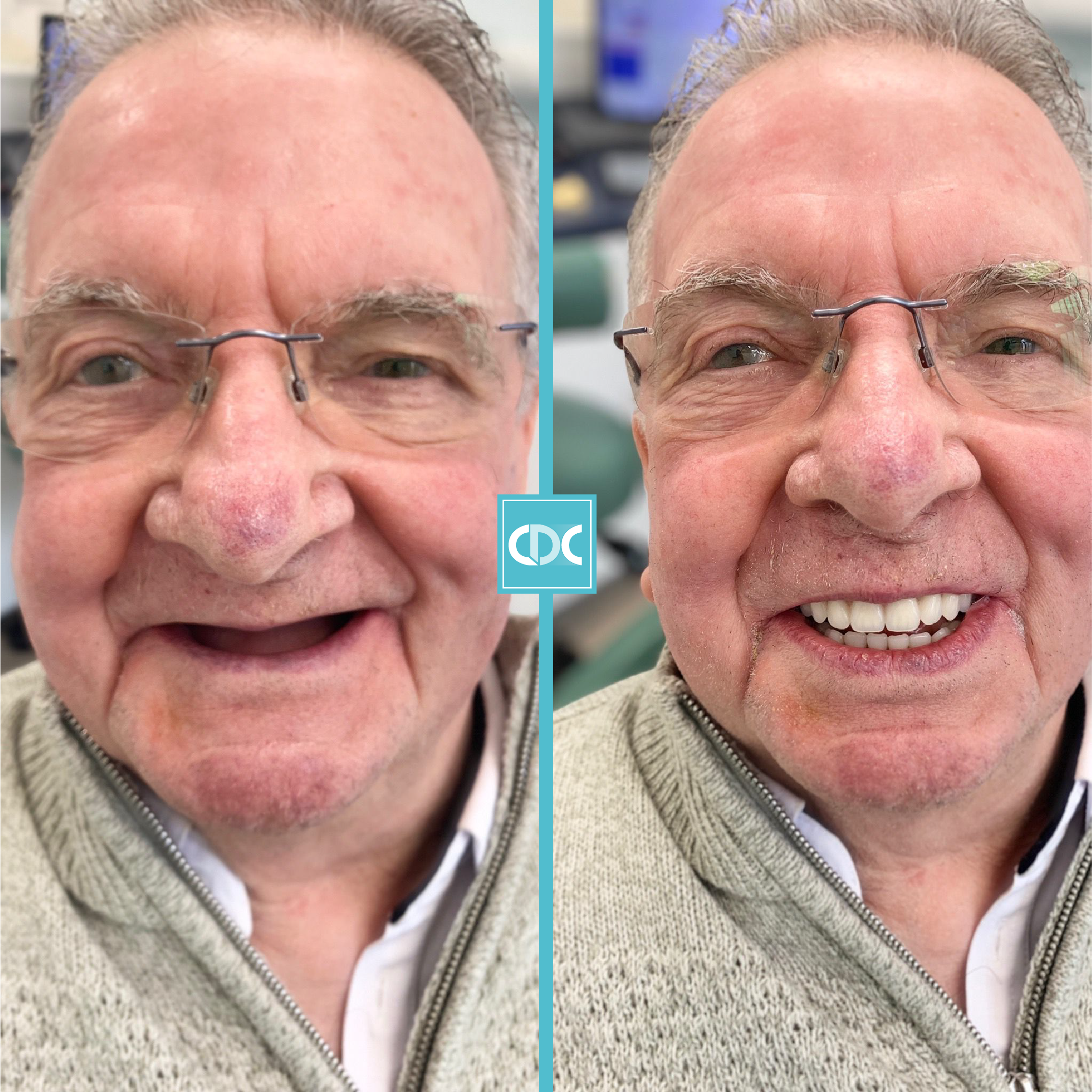 Cantley Dental Implant Implants Teeth Dentist Cosmetic Doncaster smile makeover Yorkshire Implant Open Day