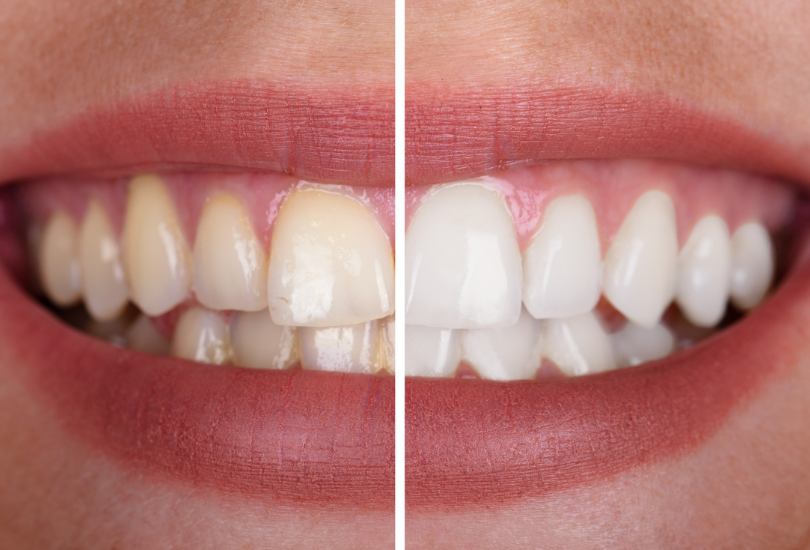 Teeth Whitening Doncaster Dentist